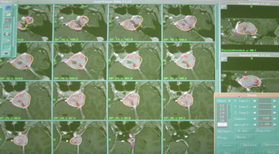 Treatment planning for Gamma Knife radiosurgery